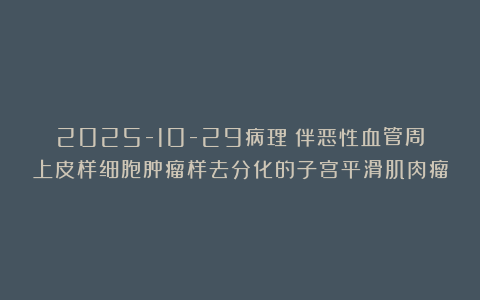 2025-10-29病理:伴恶性血管周上皮样细胞肿瘤样去分化的子宫平滑肌肉瘤