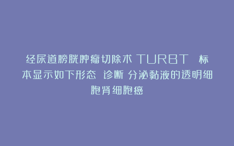 经尿道膀胱肿瘤切除术(TURBT) 标本显示如下形态 诊断?分泌黏液的透明细胞肾细胞癌